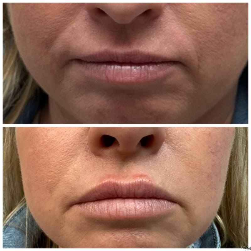 Botox & Filler Injections