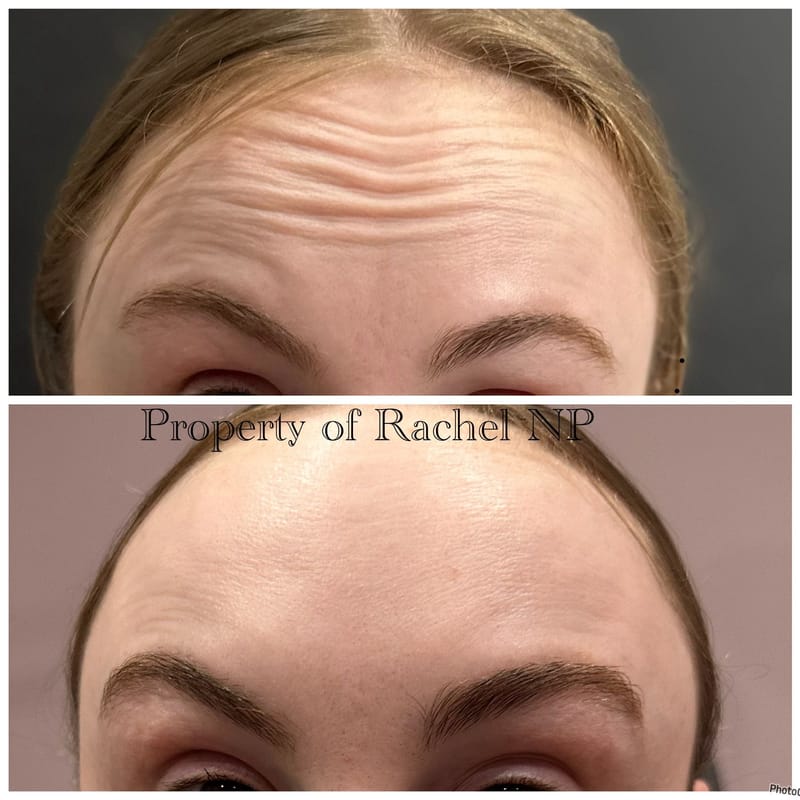 Botox & Filler Injections