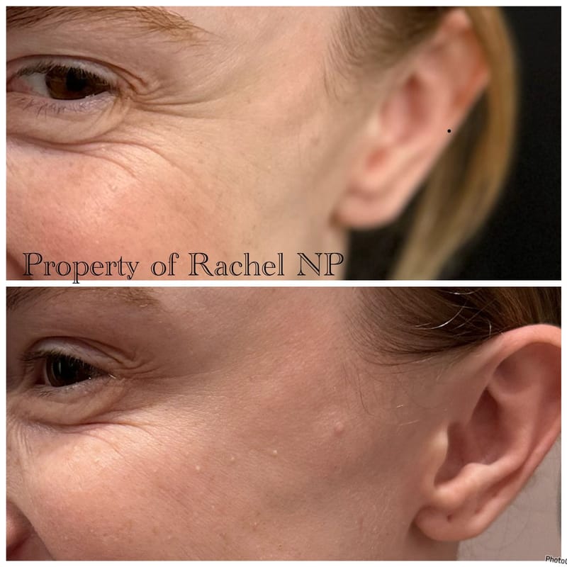 Botox & Filler Injections