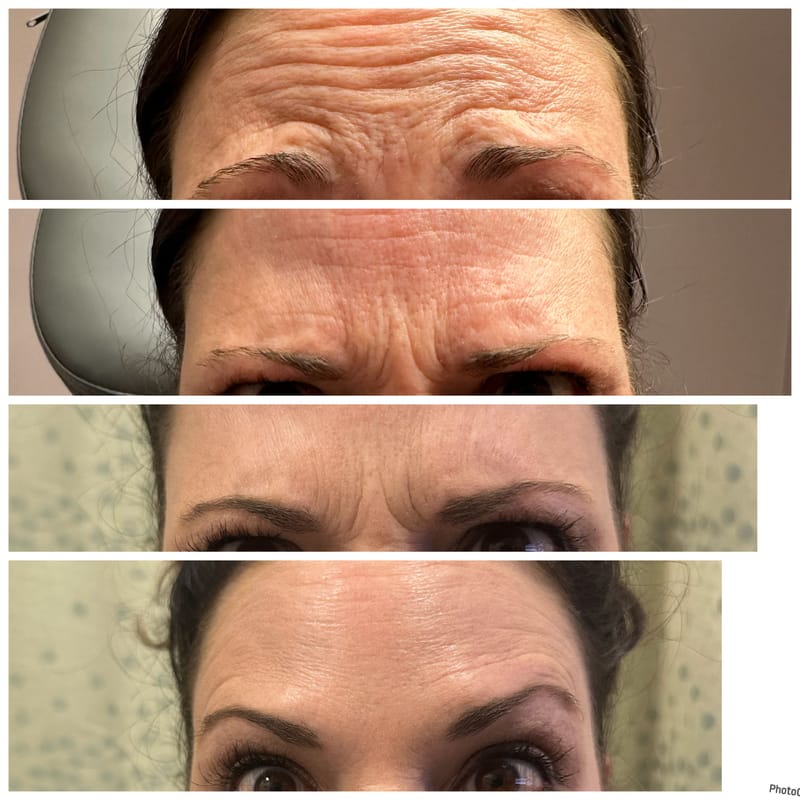 Botox & Filler Injections