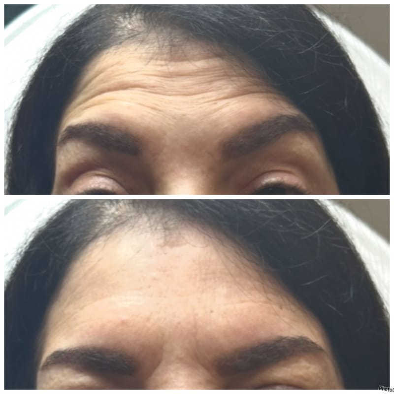 Botox & Filler Injections