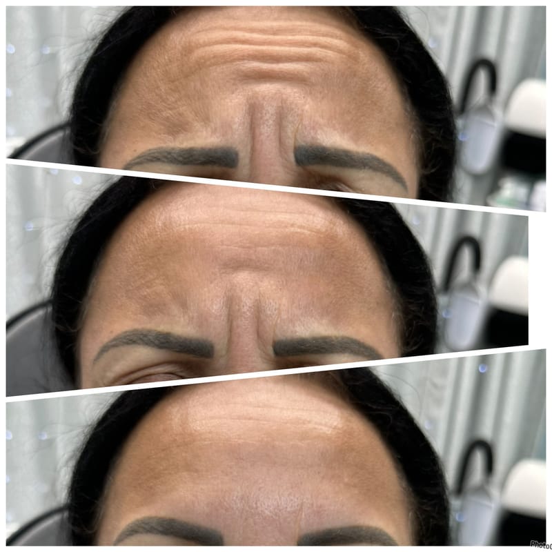 Botox & Filler Injections