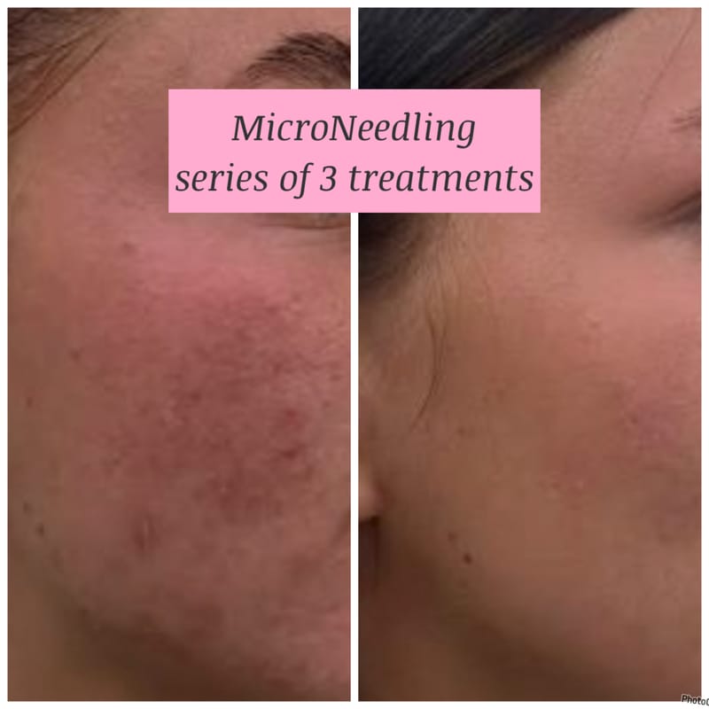 Microneedling Treatments