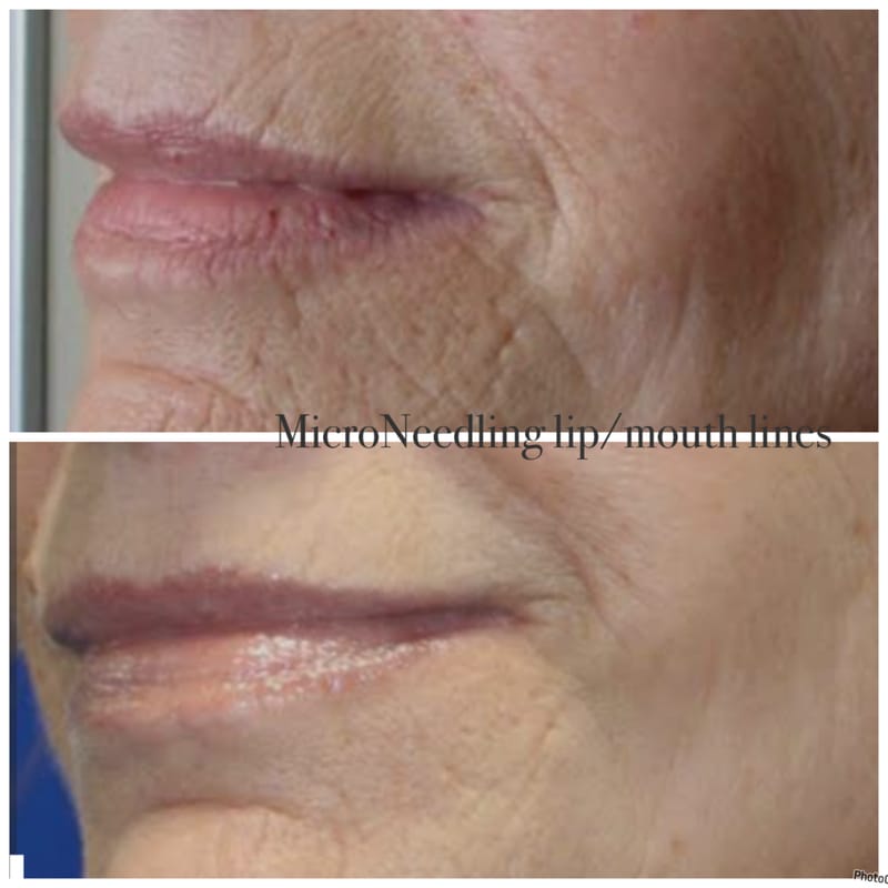 Microneedling Treatments
