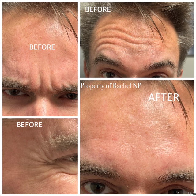 NeuroToxin Injections