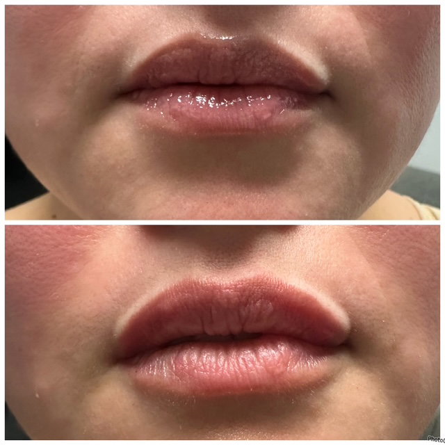 Tox (flip) & Filler Injections