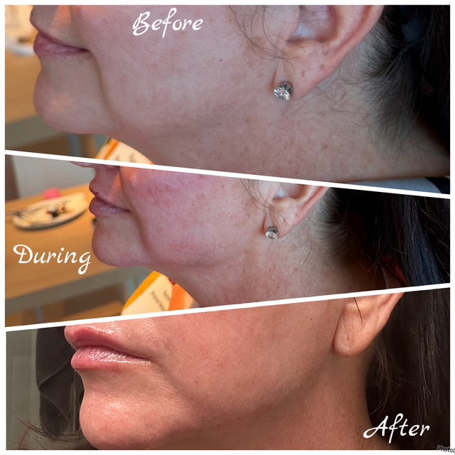 Full Face Treatments