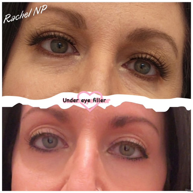 Full Face Treatments