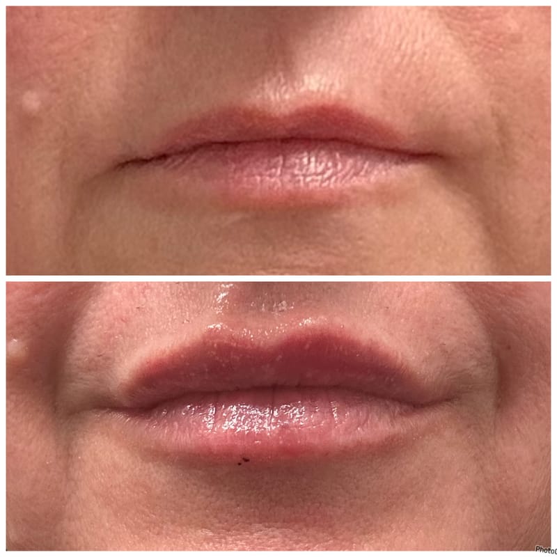 Tox Lip Flip & Filler Injections