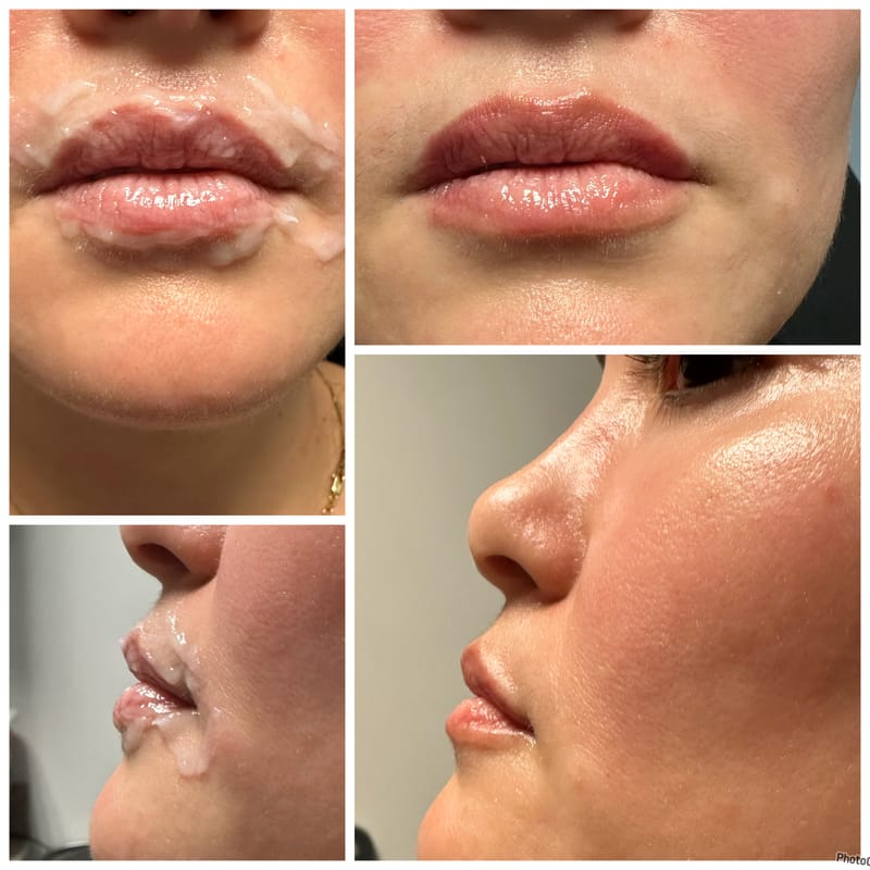 Tox Lip Flip & Filler Injections