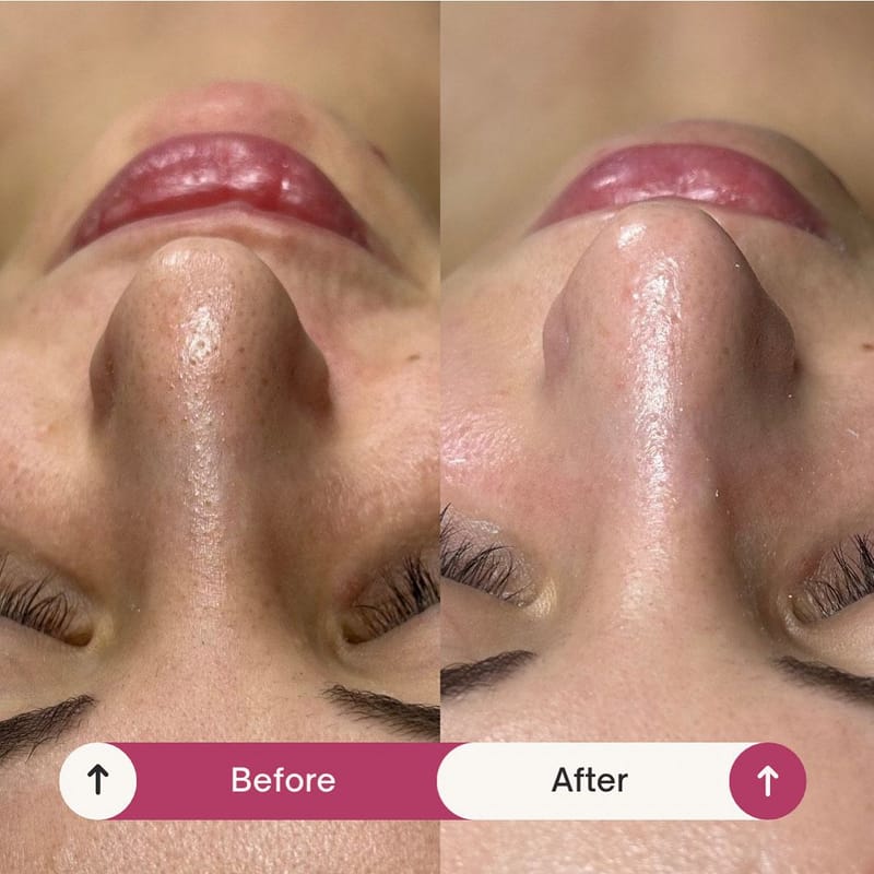 Arkana Hámlasztó Hatású Hidrogén Kezelés - AquaClean Gépi Mélytisztítással