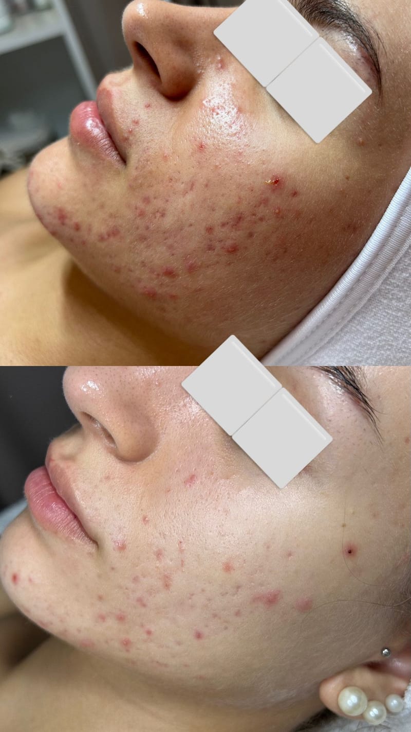 Pattanásos Bőr Speciális Kezelése