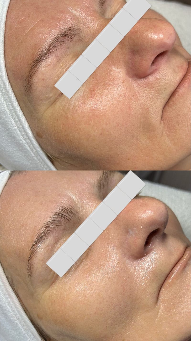 Arkana Neuro Cannabis Therapy Kezelés - Aquaclean Gépi Előtisztítással