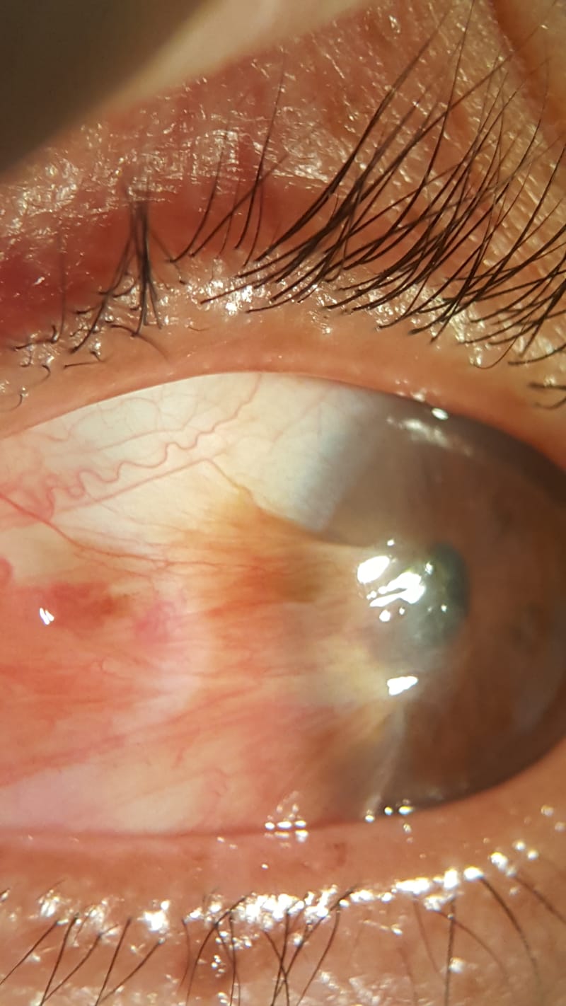 Comprehensive Management of Pterygium