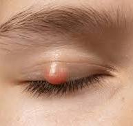 Specialized Management of Chalazion