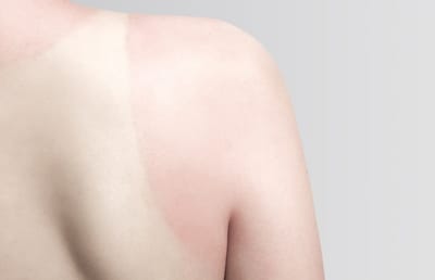 Importance of timing in reconstructive burn surgery