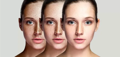 Melasma Treatment: Benefits for All Ages and Genders