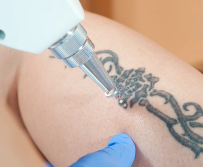 Laser Tattoo Removal: From Dark Ink to Bare Skin