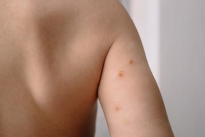 Warts Removal Surgery for Feet and Hands