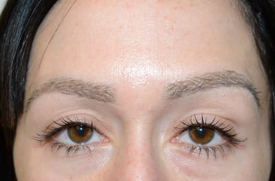 Change Your Look with Eyebrow Hair Transplant Offers