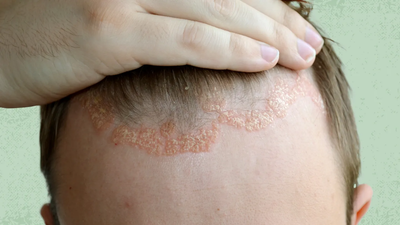 Can a dermatologist treat scalp eczema on dry skin