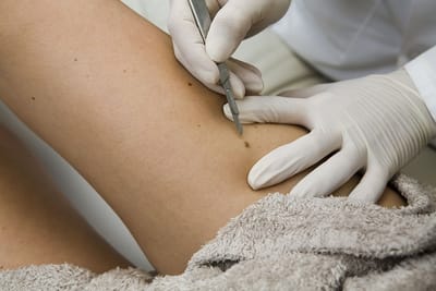 How to Remove Skin Tags on the Inner Thigh When to See a Doctor