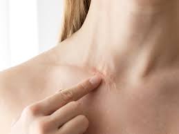 Achieve Natural Results with Surgical Scar Revision