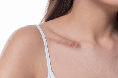 Restore Confidence with Professional Surgical Scar Revision