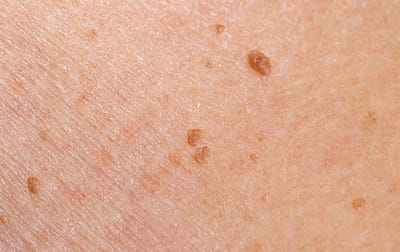 شكل الزوائد الجلدية: الدلائل البصرية والتشخيص السريع