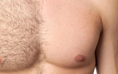 Hair Laser Treatments: Results That Last