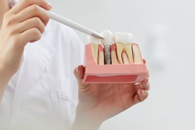 Tips for Children or Teens Needing Dental Implants