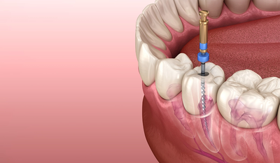 Best Food Choices After Root Canal Treatment