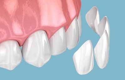 Dental Veneers Guide: Types, Costs, and Lifespan