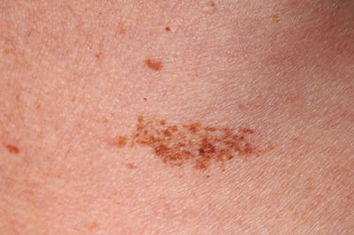 How to Get Rid of Birthmarks Permanently