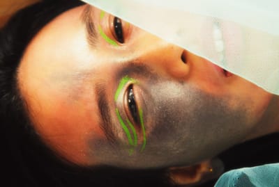 Laser Mole Removal Dubai Fast, Safe & Painless