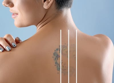 Tattoo Removal in Dubai: Laser Techniques Explained