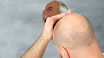 Hair Transplant Dubai Pre-Procedure Tips for Success