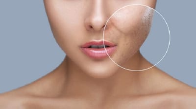 Smooth Skin in 2025: Dubai Acne Scar Treatments Guide