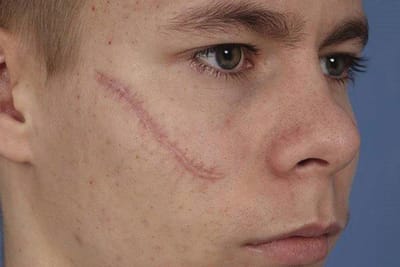 Dubai Facial Scar Clinics: Affordable & Trusted