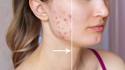 Clear Skin Guide: Acne Removal in Dubai
