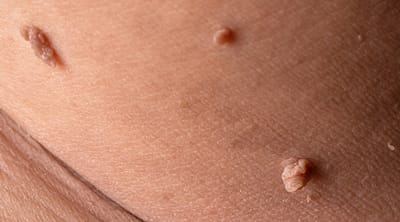 Skin Tag Removal: Causes, Treatment & Prevention