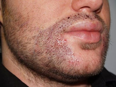 Mustache Hair Transplant Risks to Know