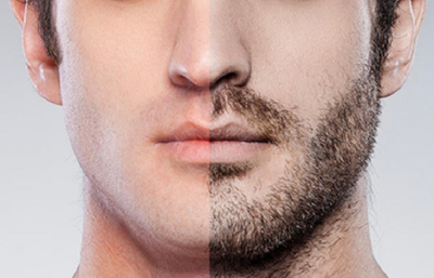 Beard Hair Transplant Dubai: Expert Insights & Updates