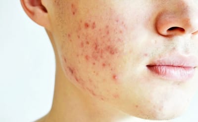 Acne Scar Treatments Dubai: Complete Overview