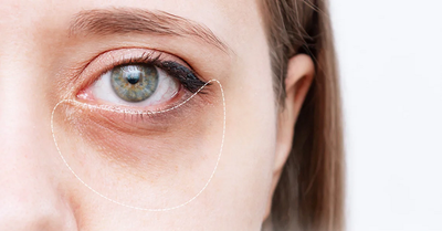 Top Rated Dark Circles Treatment Clinics In Dubai 2026