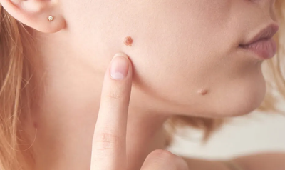 Fast and Painless Warts Removal Treatments in Dubai