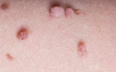Skin Tag Removal in Dubai: Home Remedies vs Clinic Treatments