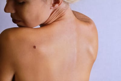 Birthmark Removal Treatment Dubai: Step by Step Guide