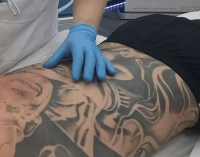 Affordable & Safe Laser Tattoo Removal Dubai Clinics