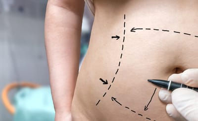 Dubai Laser Liposuction Clinics: Reviews & Ratings